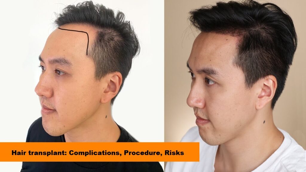 Hair transplant: Complications, Procedure, Risks Hair transplant