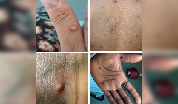 Maryland Department Of Health Releases Human Monkeypox Data Dashboard New Project 2022 06 17T124859.978