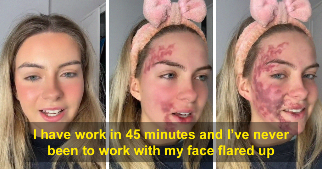 Woman With Rare Skin Condition Films Flare Up Nancy Morel Fb 63a04988b87b7 1024x538